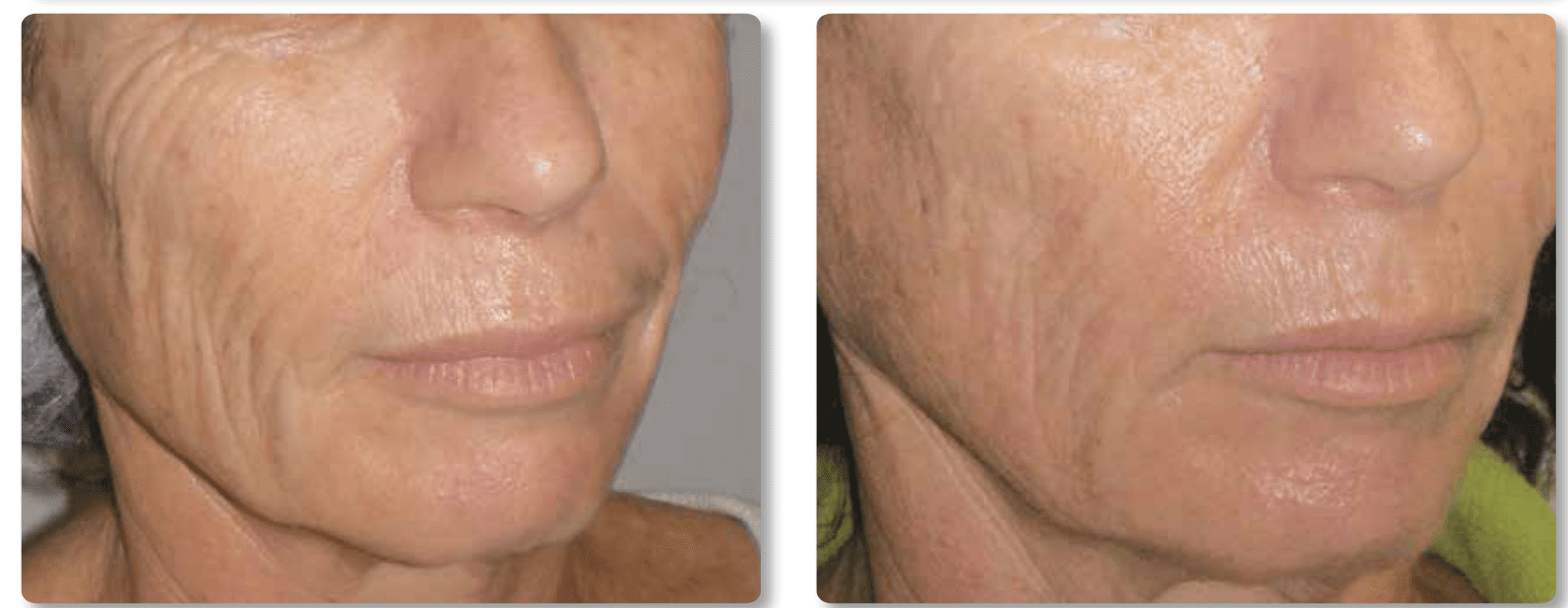 lower face skin tightening