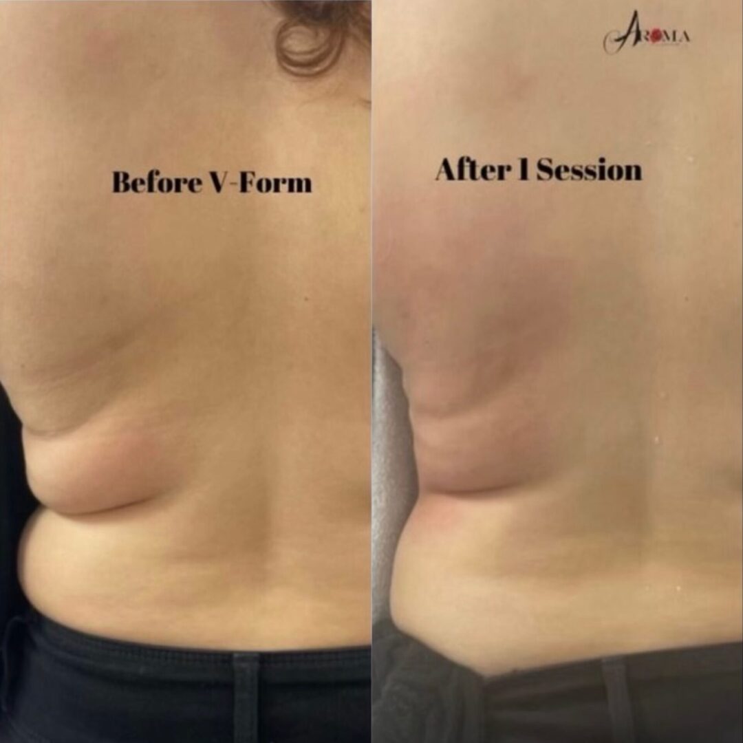 vform body contouring back and sides