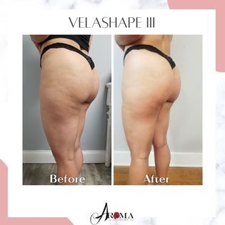 velashape iii velashape iii